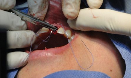 Implant dentaire par votre dentiste à Nice